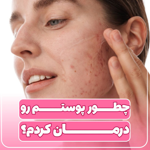 چطوری پوستم رو درمان کنم از دست جوش و لک